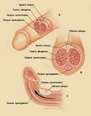 PHALLOSAN forte - Therapy for Induratio penis plastica (IPP).